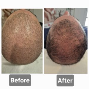 Mesotherapie Mesotherapy haaruitval mesotherapie haar haar injecties XL hair