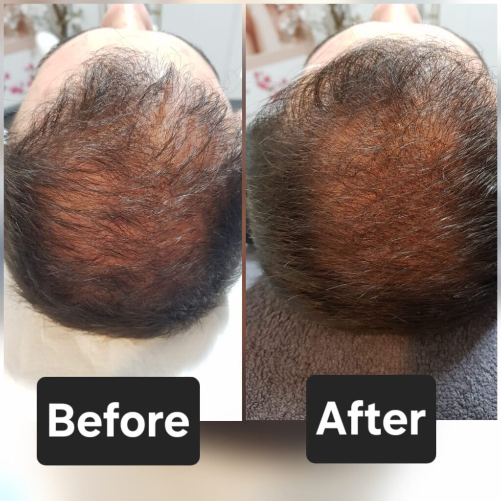 Mesotherapie haar Mesotherapy haaruitval XL hair