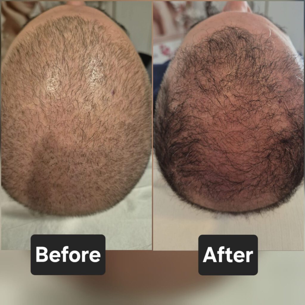 Mesotherapie haar Mesotherapy haaruitval XL hair